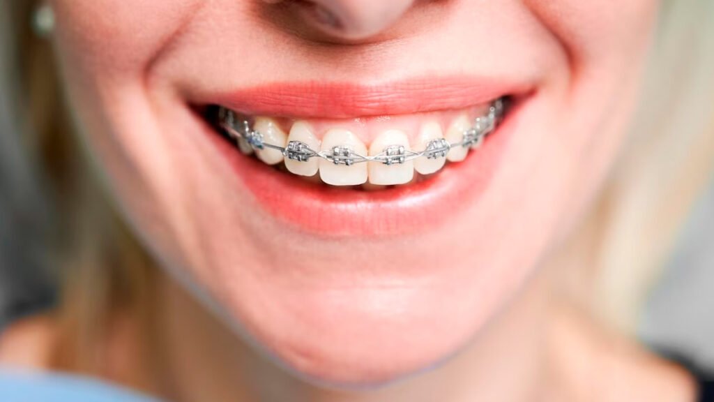 para que sirven los brackets